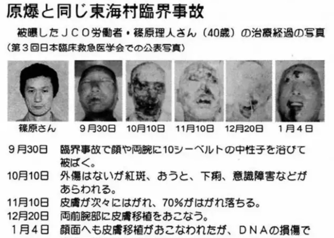 日本东海村核临界事故-治疗核辐射83天的记录 剧照9