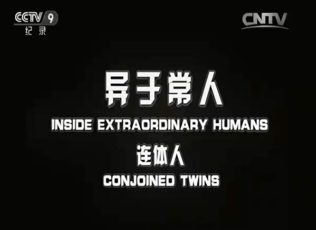 异于常人:连体人 剧照2
